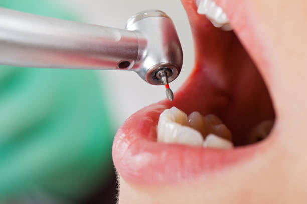Best Emergency Tooth Extraction in Grants Pass, OR